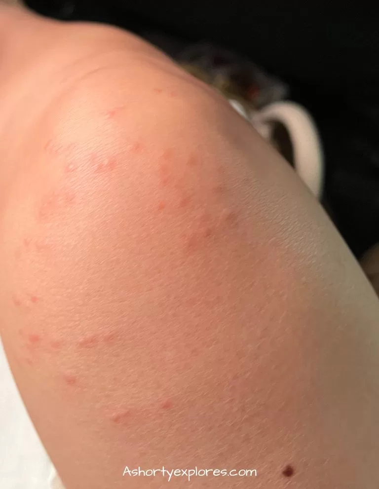 bedbug bite